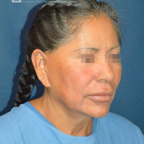 60yo__Female-Complete-Lower-facelift__before-2