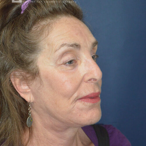 71yo__Female-Lower-facelift,-upper-and-lower-blepharoplasty,-fat-transfer-to-the-face,-CO2-laser-around-mouth-and-eyes__after-1
