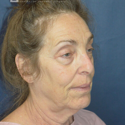 71yo__Female-Lower-facelift,-upper-and-lower-blepharoplasty,-fat-transfer-to-the-face,-CO2-laser-around-mouth-and-eyes__before-1