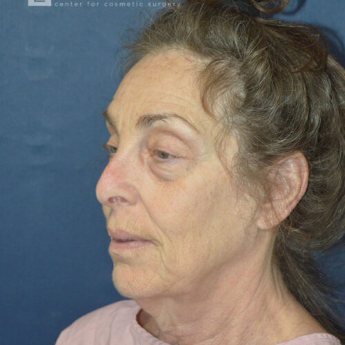 71yo__Female-Lower-facelift,-upper-and-lower-blepharoplasty,-fat-transfer-to-the-face,-CO2-laser-around-mouth-and-eyes__before-2