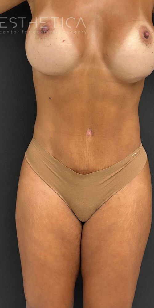 Esthetica-case-before-after__360-Lipo-abdominal-plasty-breast-augmentation__15-08__after__4